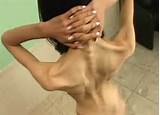 Anorexic Porn Click Here For Super Skinny Girls In Porn