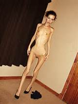 Anorexic Porn Image 879489